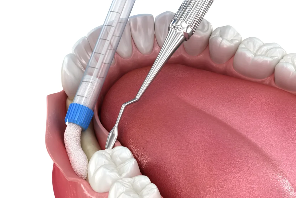 When Is Bone Grafting Needed for Dental Implants? Dental Bone Grafting Stuart FL