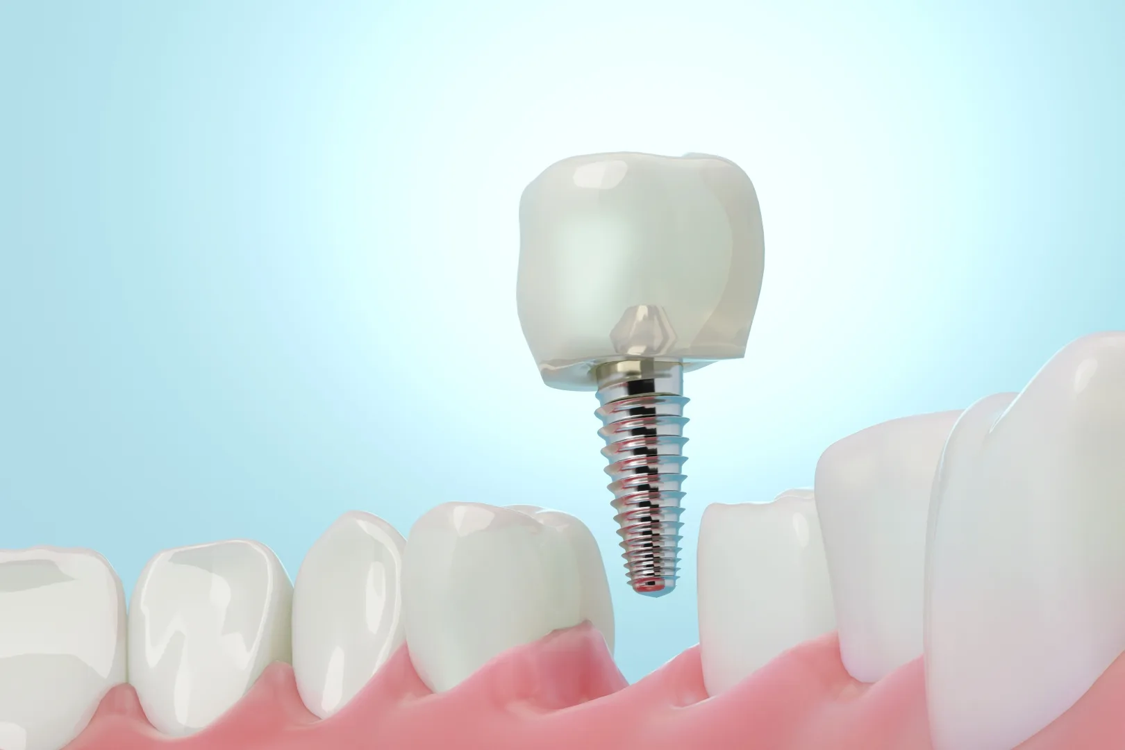 Stuart FL Single Tooth Dental Implants Single Tooth Dental Implants Stuart FL