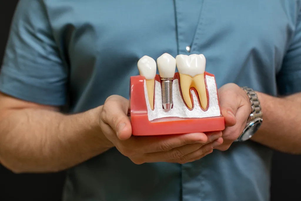 How long do full-mouth dental implants last