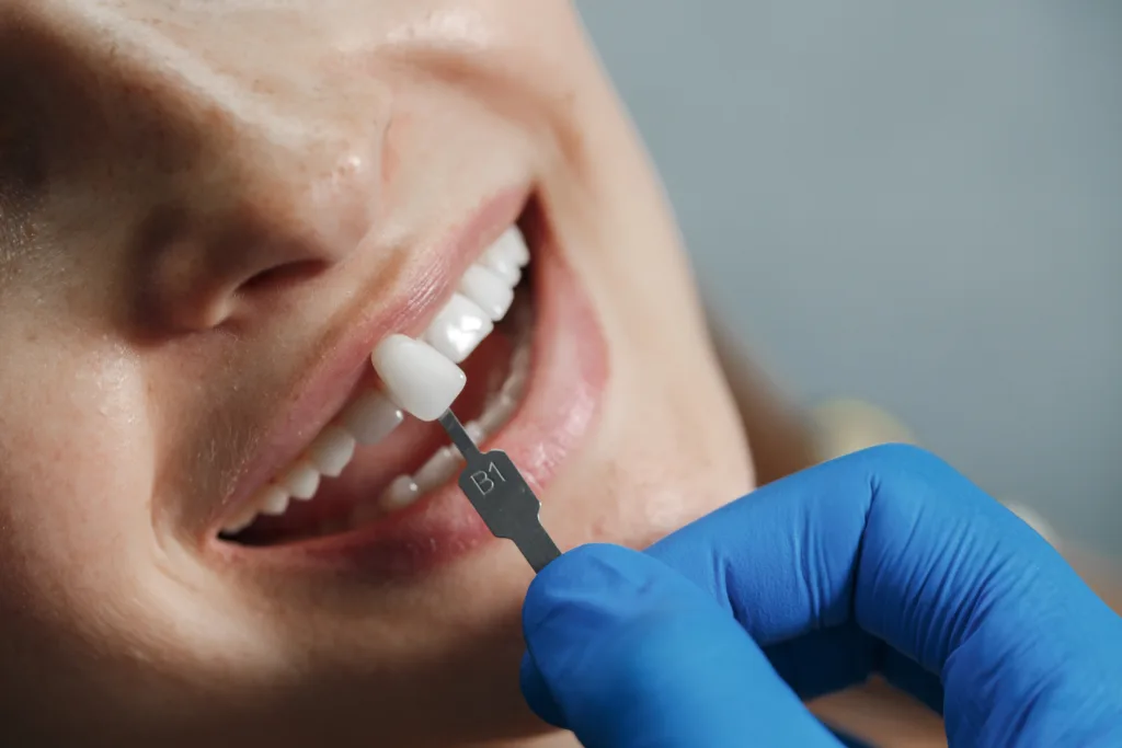 Everything You Need to Know Before Getting Veneers