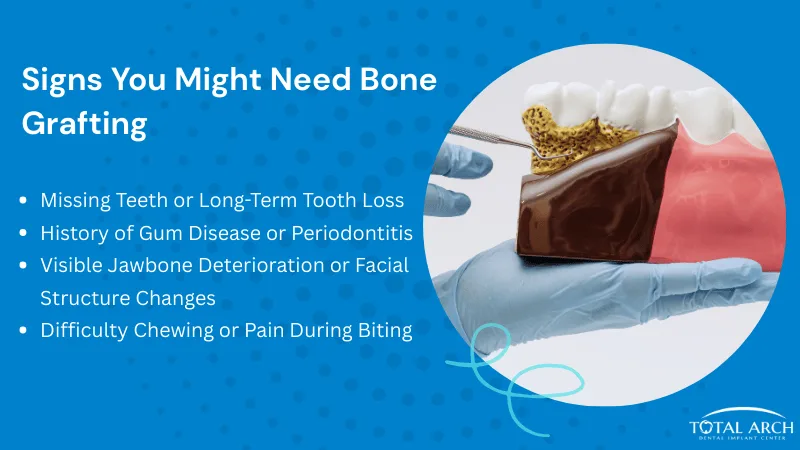 Common Signs You May Need Bone Grafting